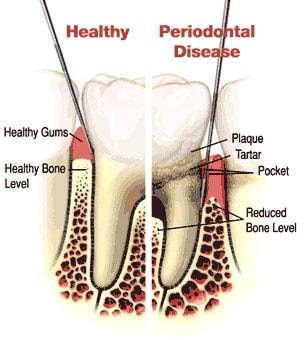The Difference Between Healthy Gums and Unhealthy Gums