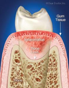 inflammatory-periodontal-disease