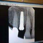 x-ray showing dental implant