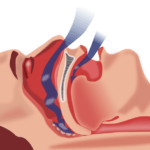 obstructive sleep apnea diagram