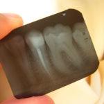 x-ray of root canal tooth
