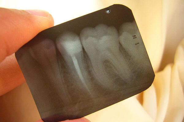 x-ray of root canal tooth